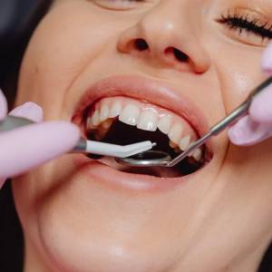 5 Most Widely Known Factors That Lead to Tooth Extractions in Newark