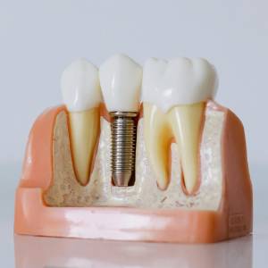 7 Signs that You Need an Implant Dentist in Newark 7 Signs that You Need an Implant Dentist in Newark