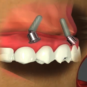All-on-4 Implant-Supported Dentures: How They Can Benefit You?