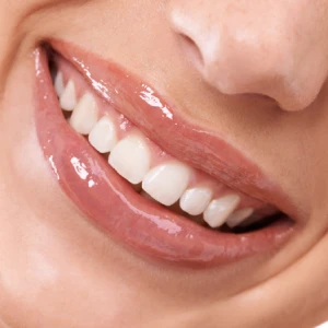 Are You a Good Candidate for Teeth Whitening in Newark?