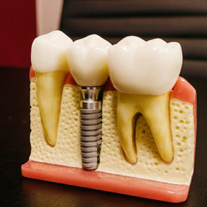 Can a Cosmetic Dentist Install Dental Implants?