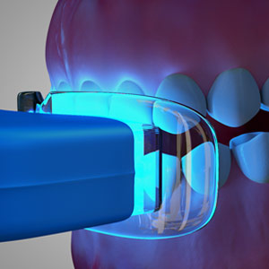 Can I Whiten My Teeth Even if I Have Gum Disease? | Newark Can I Whiten My Teeth Even if I Have Gum Disease?