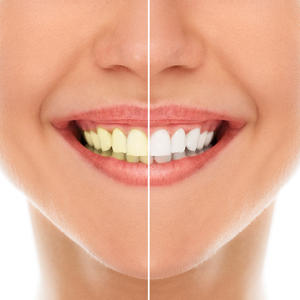 Essential Facts About Teeth Whitening | Newark, NJ