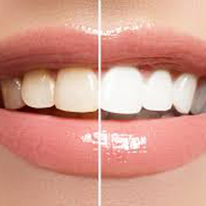 Is Teeth Whitening Effective With Dental Crowns? | Newark