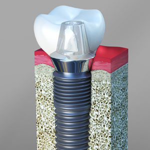 Why Periodontist Is Best for Dental Implants? | Newark, NJ
