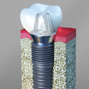 Why Periodontist Is Best for Dental Implants? | Newark, NJ Why Periodontist Is Best for Dental Implants? | Newark, NJ